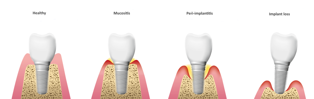 Peri-implantite